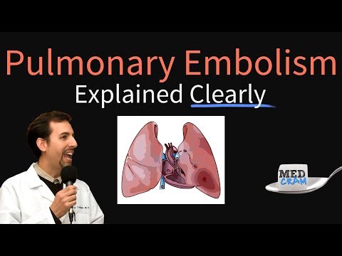 Pulmonary Embolism Explained Clearly - Risk factors, Pathophysiology, DVT, Treatment
