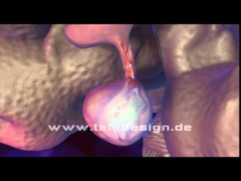 RF Thermo der Prostata Chinesische Gewebe der Prostata
