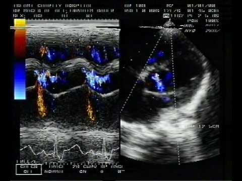 Coronary Artery To Left Ventricle Fistula (1/4)