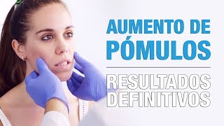 Aumento de Pómulos con Implantes |  Clínicas Diego de León
