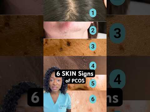 6 Ways PCOS Can Show Up on Your Skin | Polycystic Ovary Syndrome