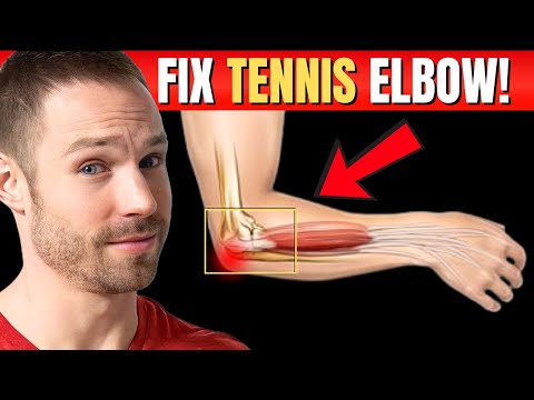 How to Fix Tennis Elbow FOREVER (No Surgery!)