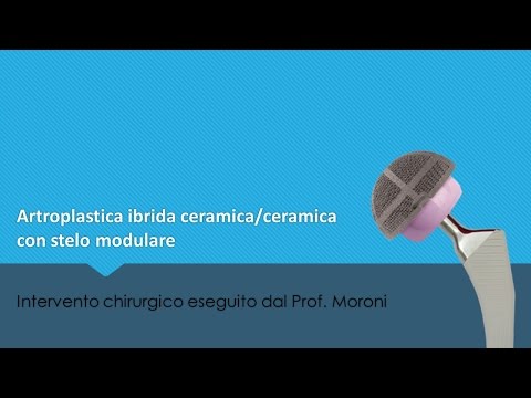 Spalla chiusa pregiudizio comune ICD-10 Video.zaryadka con il video osteocondrosi cervicale