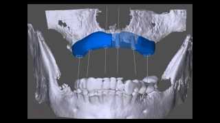 preview picture of video 'Knochenaufbau im Oberkiefer mit vier Knochenblöcken aus Spendermaterial - Niliusklinik Dortmund'