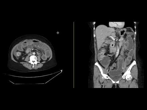 Small bowel obstruction