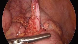 Retrocecal appendix Retrocecal appendix
