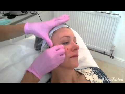 Skin Renaissance - FTC PDO Thread Lifting Treatment