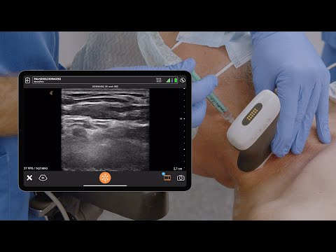 USG Interscalene Block