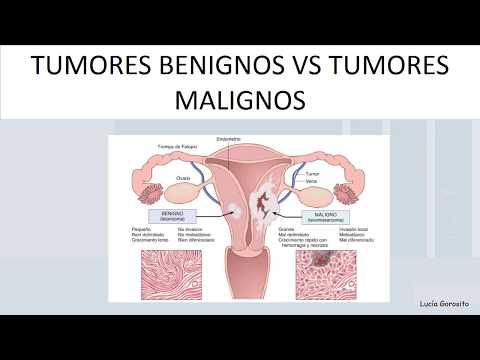 Neoplasias. Características de las neoplasias benignas y malignas