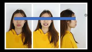 Case lâm sàng Hạng 2 góc thấp/cắn sâu có nhổ 4R4 - Cơ học kéo lui và lún toàn hàm
