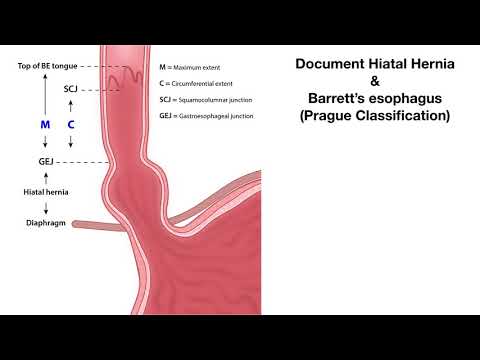 Classification de Prague - œsophage de Barrett - animation