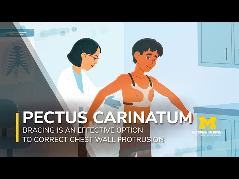 How Michigan Medicine Treats Pectus Carinatum