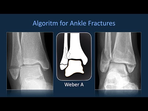 Algoritm for Ankle Fractures