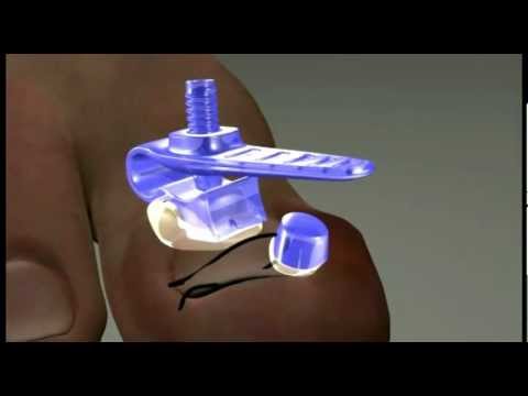 Halamang-singaw sa kuko ng hinlalaki ng paa paggamot ng folk Diskarteng hardware paggamot ng kuko halamang-singaw