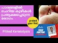 PITTED KERATOLYSIS MALAYALAM  പാദങ്ങളിൽ ചെറിയ കുഴികൾ പ്രത്യക്ഷ