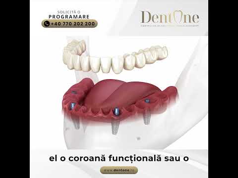 Recapătă-ți zâmbetul: implantul dentar, una dintre cele mai sigure proceduri moderne
