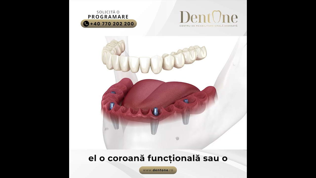 Recapătă-ți zâmbetul: implantul dentar, una dintre cele mai sigure proceduri moderne