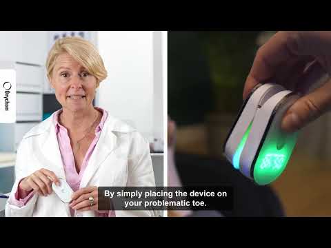 Onychom - Antifungal Laser Device - CWAF1