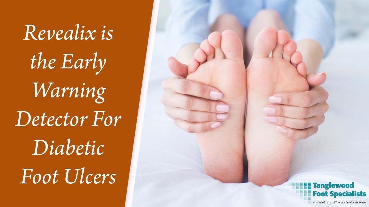 Revealix is the Early Warning Detector For Diabetic Foot Ulcers