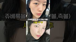 울퉁불퉁 얼굴형 관리 전후