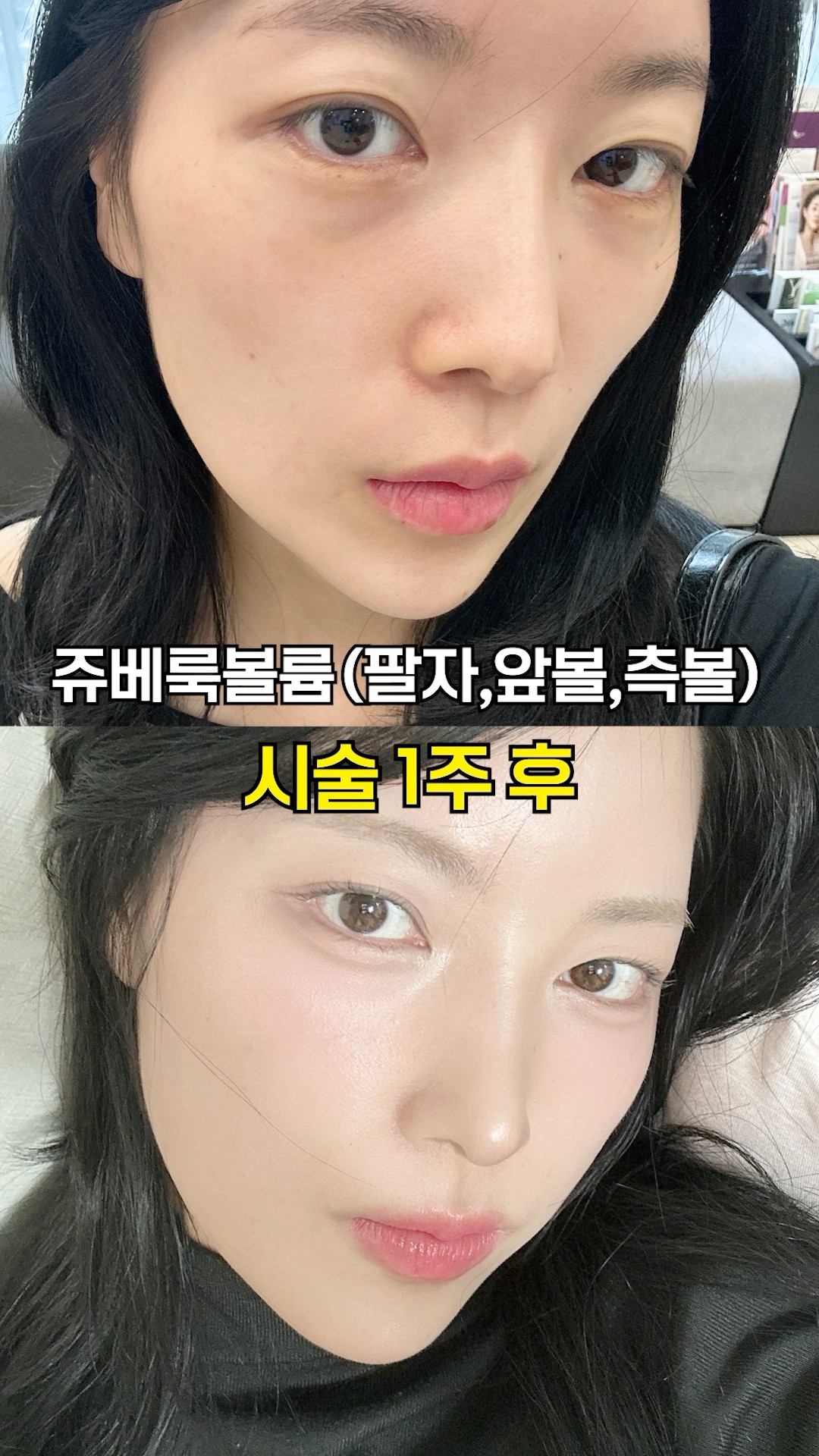 울퉁불퉁 얼굴형 관리 전후