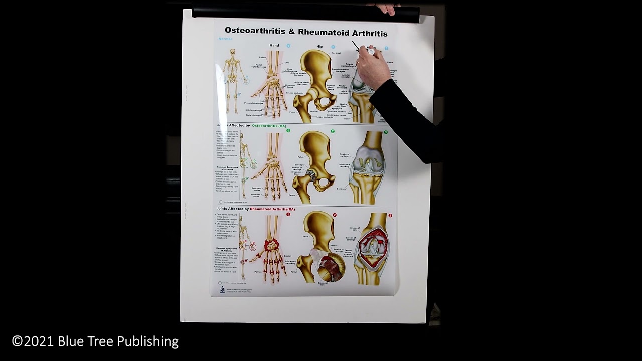 Osteoarthritis and Rheumatoid Arthritis Large Poster