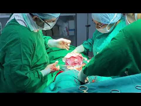Lower Segment Caesarean Section (LSCS)