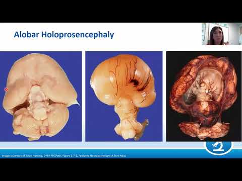 AANP Teaching Rounds - February 24, 2021 - Pediatric Neuropathology: Malformations