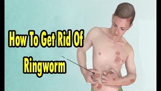 How To Get Rid Of Ringworm Fast Permanently Naturally At Home
