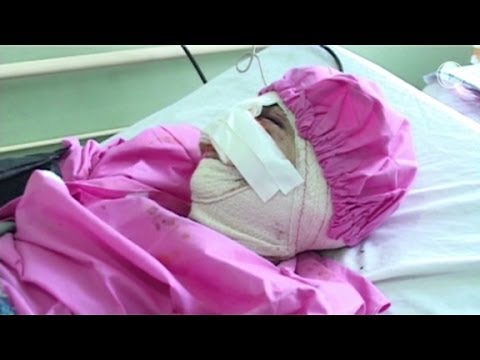 زوج يقطع أنف وشفتي زوجته بعد أن رفضت بيع مجوهراتها ليشتري به الهيروين