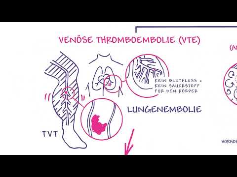 Tiefe Venen-Thrombose, Vorhofflimmern, Akutes Koronarsyndrom – Blutgerinnsel und möglichen Folgen