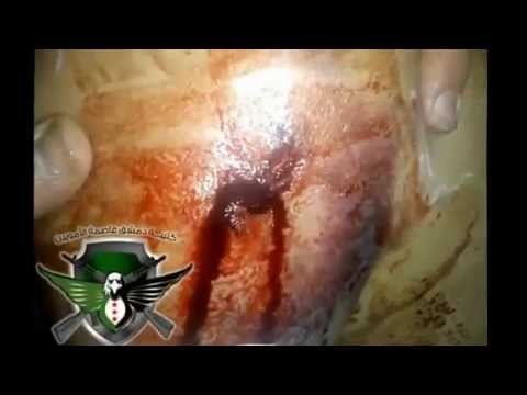 إسعاف أحد عناصر كتيبة دمشق عاصمة الأمويين جراء اصابة في يده