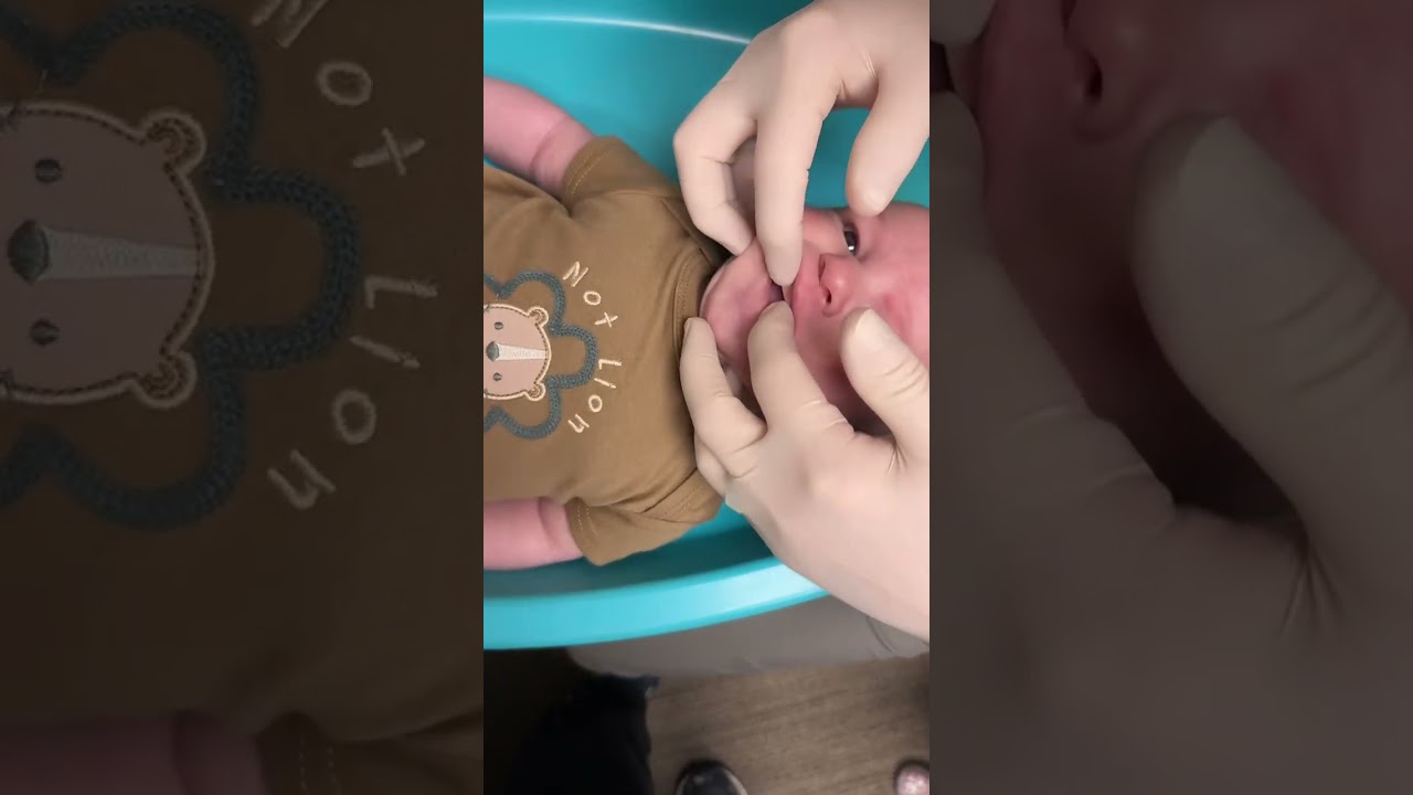 Tongue Tie & Lip Tie Stretches and Wound Care for Infants