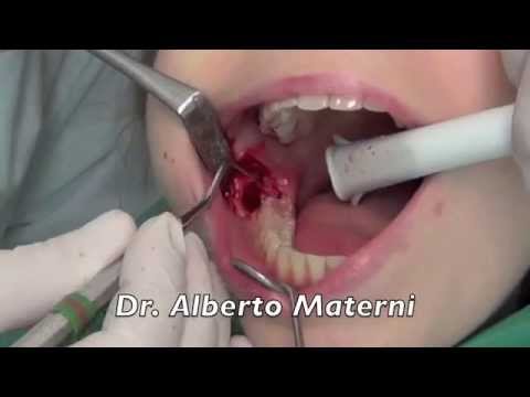 Dislocazione dei sintomi vertebre cervicali trattamento Recensioni di chirurgia sulla spalla