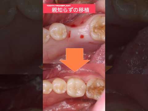 生命歯学科 親知らずの移植により歯を残す🦷 歯牙レプリカと再生療法を併用した欠損部分に対して行う歯牙移植法 #shorts #口腔外科 #歯牙移植  #親知らず