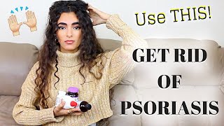 HOW TO GET RID OF PSORIASIS.. SERIOUSLY!