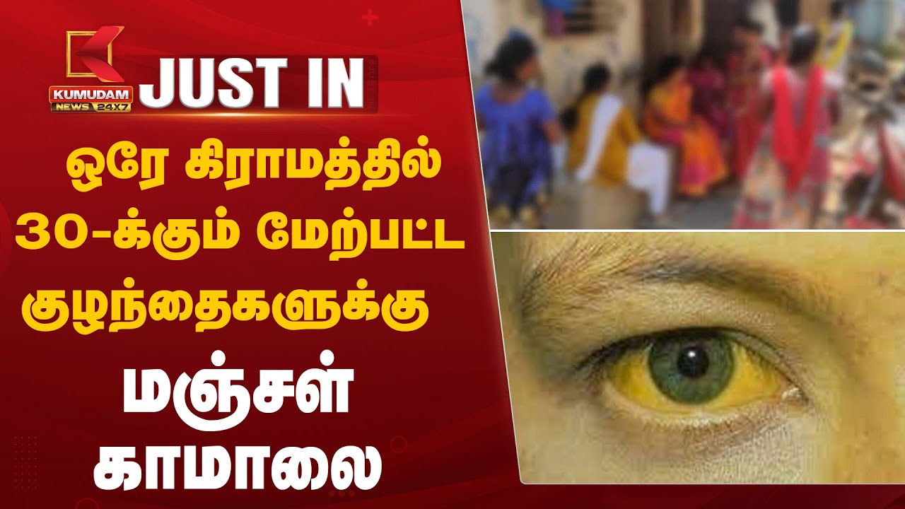 ஒரே கிராமத்தில் 30-க்கும் மேற்பட்ட குழந்தைகளுக்கு மஞ்சள் காமாலை..  அரசுக்கு பெற்றோர்கள் கோரிக்கை