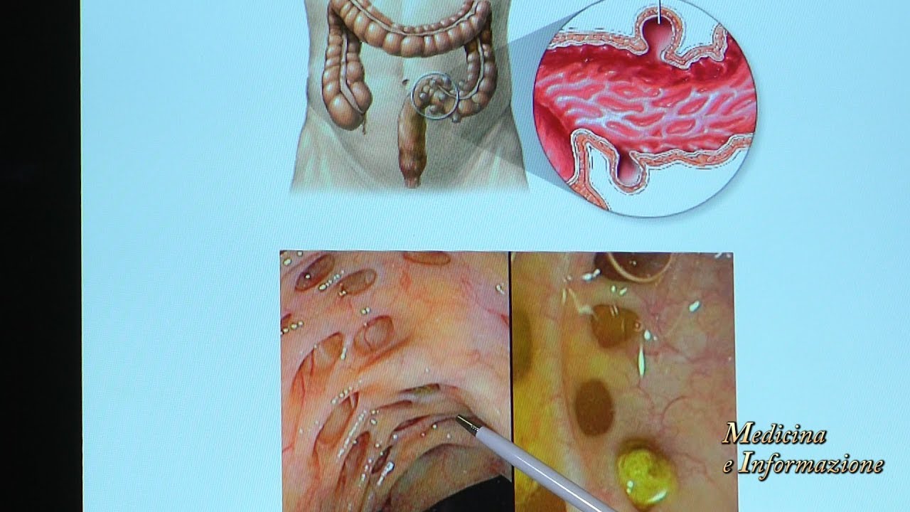 Watch Now Diverticoli: come prevenirli, cosa mangiare per evitare che si infiammino Diverticoli: come prevenirli, cosa mangiare per evitare che si infiammino