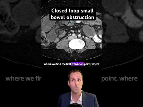 Abdominal CT Tutorials - Closed loop small bowel obstruction