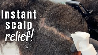 She Just Got A Whole New Scalp! Only Twelve12 Products Were Used.