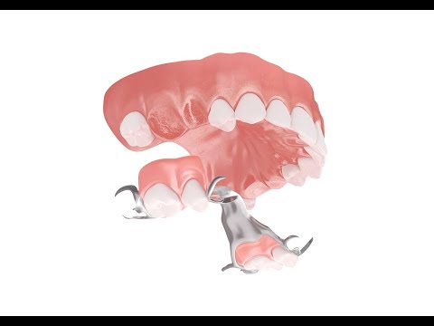 Behandlungsablauf: Klammerprothese - Zahnersatzsparen.de