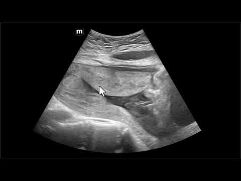 Cinco complicações de cesariana diagnosticadas pela ultrassonografia