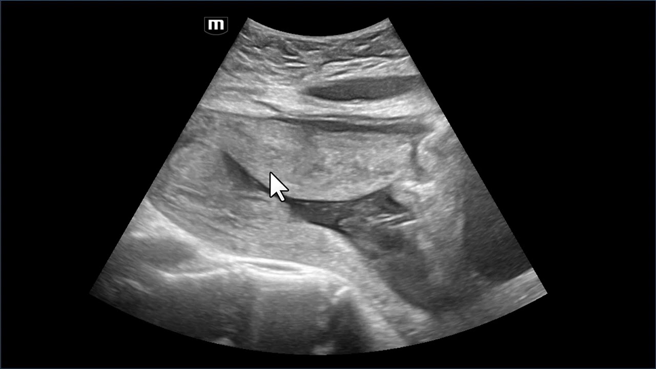 Cinco complicações de cesariana diagnosticadas pela ultrassonografia