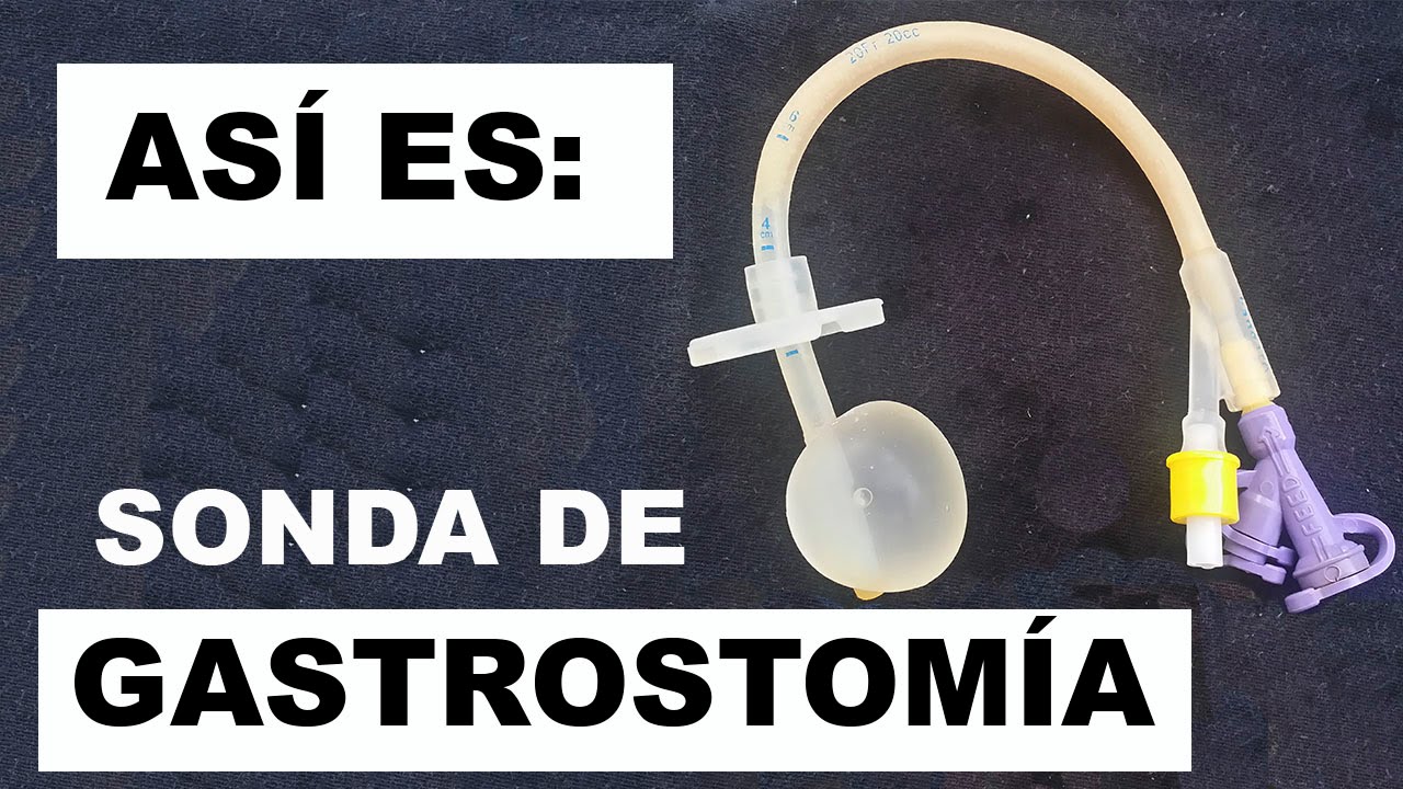 Como es una sonda de gastrostomía.