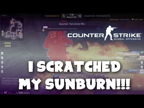 (READ DISCRIPTION) I Scratched My Sunburn!!! (Funny and Epic CSGO Moments)