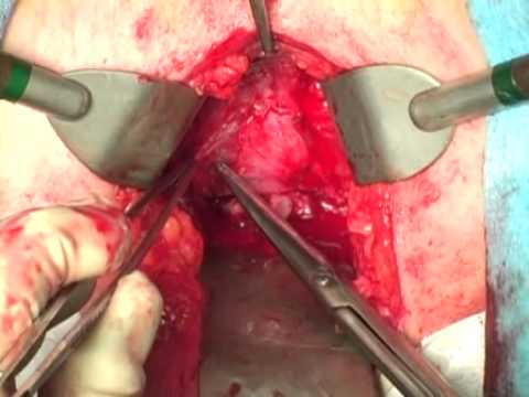 Radical Prostatectomy - Perineal Access