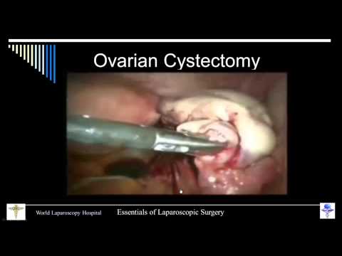Master Class of Laparoscopic Ovarian Cystectomy 
