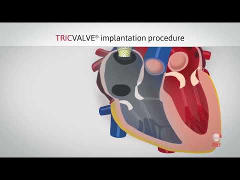 TricValve Implantation - Sistema Bicaval percutáneo para enfermedad tricuspidea.