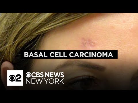 Dermatologist explains the dangers of basal cell carcinoma, what to look out for