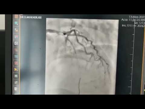 Heart Attack High Thrombus Burden and Angioplasty